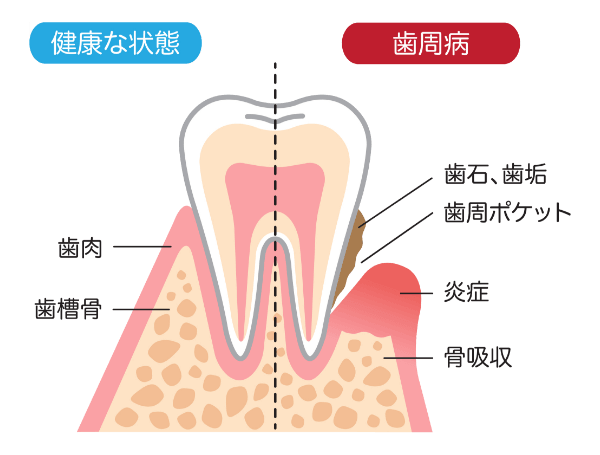 健康な状態と歯周病