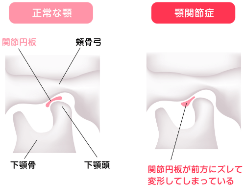 顎関節症