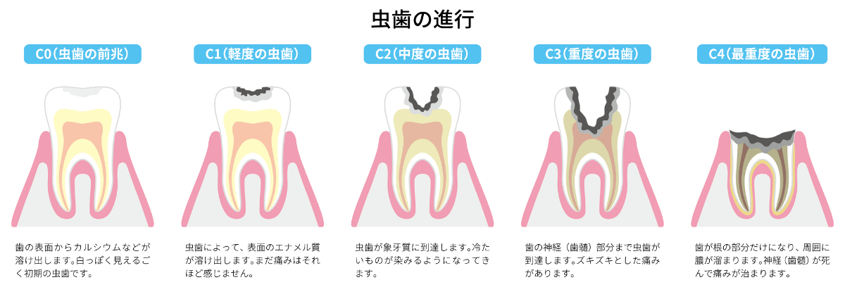 虫歯の進行