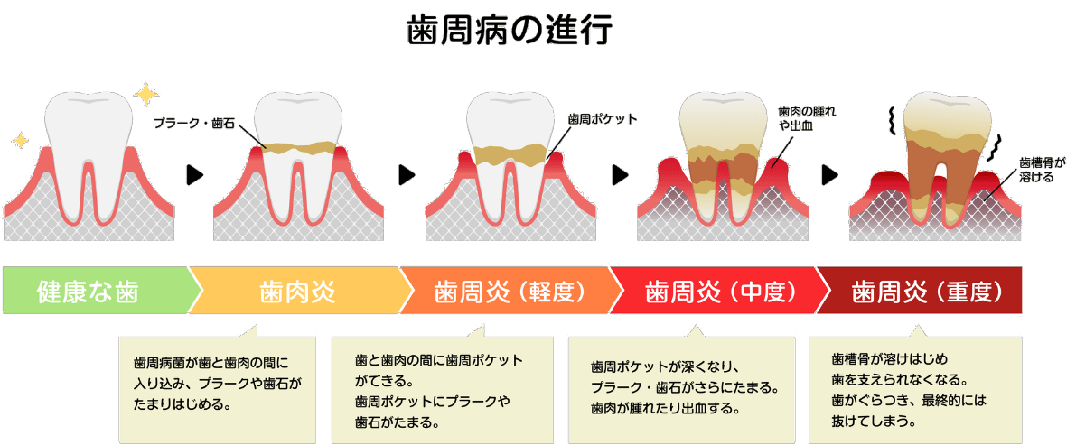 歯周病の進行