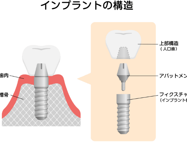 インプラントの構造