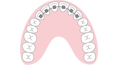 リンガルブラケット矯正